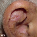basal cell carcinoma