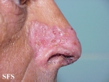 basal cell carcinoma