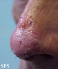 basal cell carcinoma