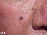basal cell carcinoma