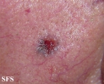 basal cell carcinoma