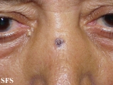 basal cell carcinoma