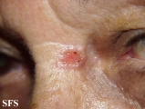 basal cell carcinoma
