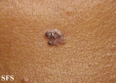 basal cell carcinoma