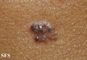 basal cell carcinoma