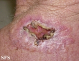 basal cell carcinoma