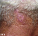 basal cell carcinoma