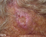 basal cell carcinoma