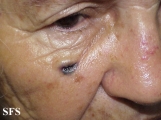 basal cell carcinoma