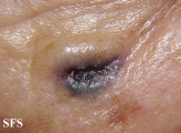 basal cell carcinoma