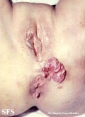 basal cell carcinoma