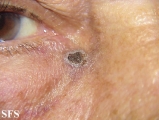 basal cell carcinoma