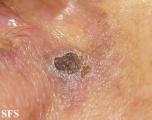 basal cell carcinoma