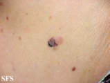 basal cell carcinoma