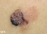 basal cell carcinoma