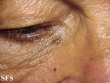 basal cell carcinoma