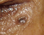 basal cell carcinoma