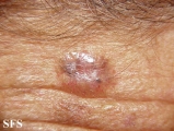 basal cell carcinoma