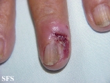 basal cell carcinoma