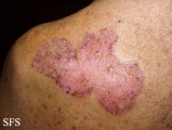 basal cell carcinoma
