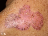 basal cell carcinoma
