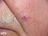 basal cell carcinoma
