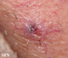 basal cell carcinoma