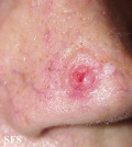 basal cell carcinoma