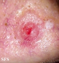 basal cell carcinoma