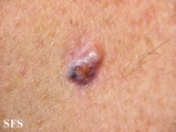 basal cell carcinoma
