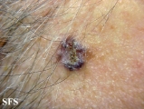 basal cell carcinoma