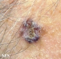 basal cell carcinoma