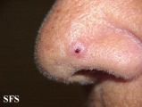 basal cell carcinoma