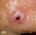 basal cell carcinoma