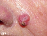 basal cell carcinoma