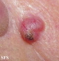basal cell carcinoma