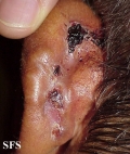 basal cell carcinoma