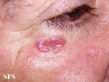 basal cell carcinoma
