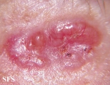 basal cell carcinoma
