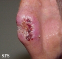 basal cell carcinoma