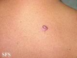 basal cell carcinoma