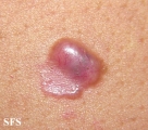 basal cell carcinoma