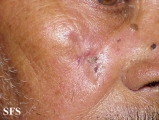 basal cell carcinoma