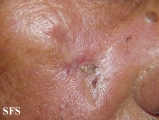 basal cell carcinoma