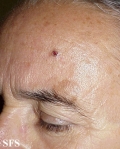 basal cell carcinoma
