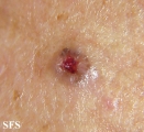 basal cell carcinoma