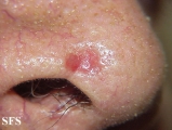 basal cell carcinoma