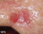 basal cell carcinoma