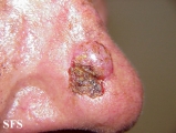 basal cell carcinoma