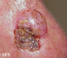 basal cell carcinoma
